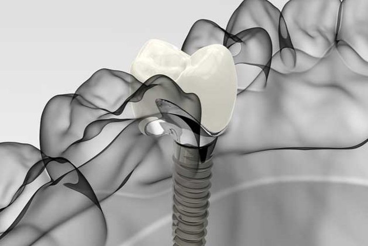 4D 디지털 임플란트